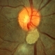 Tuberous Sclerosis